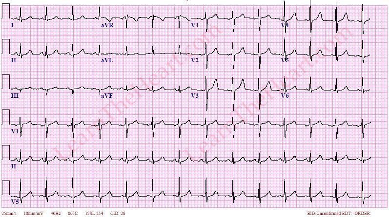 normal ECG