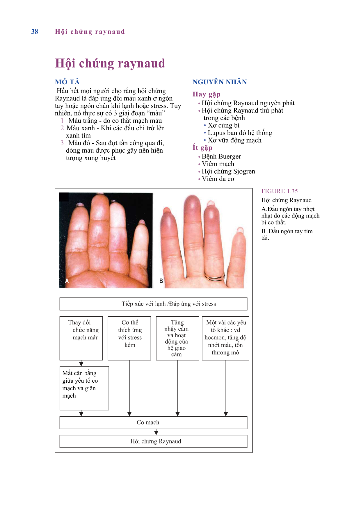 Loạn dưỡng móng do vảy nến