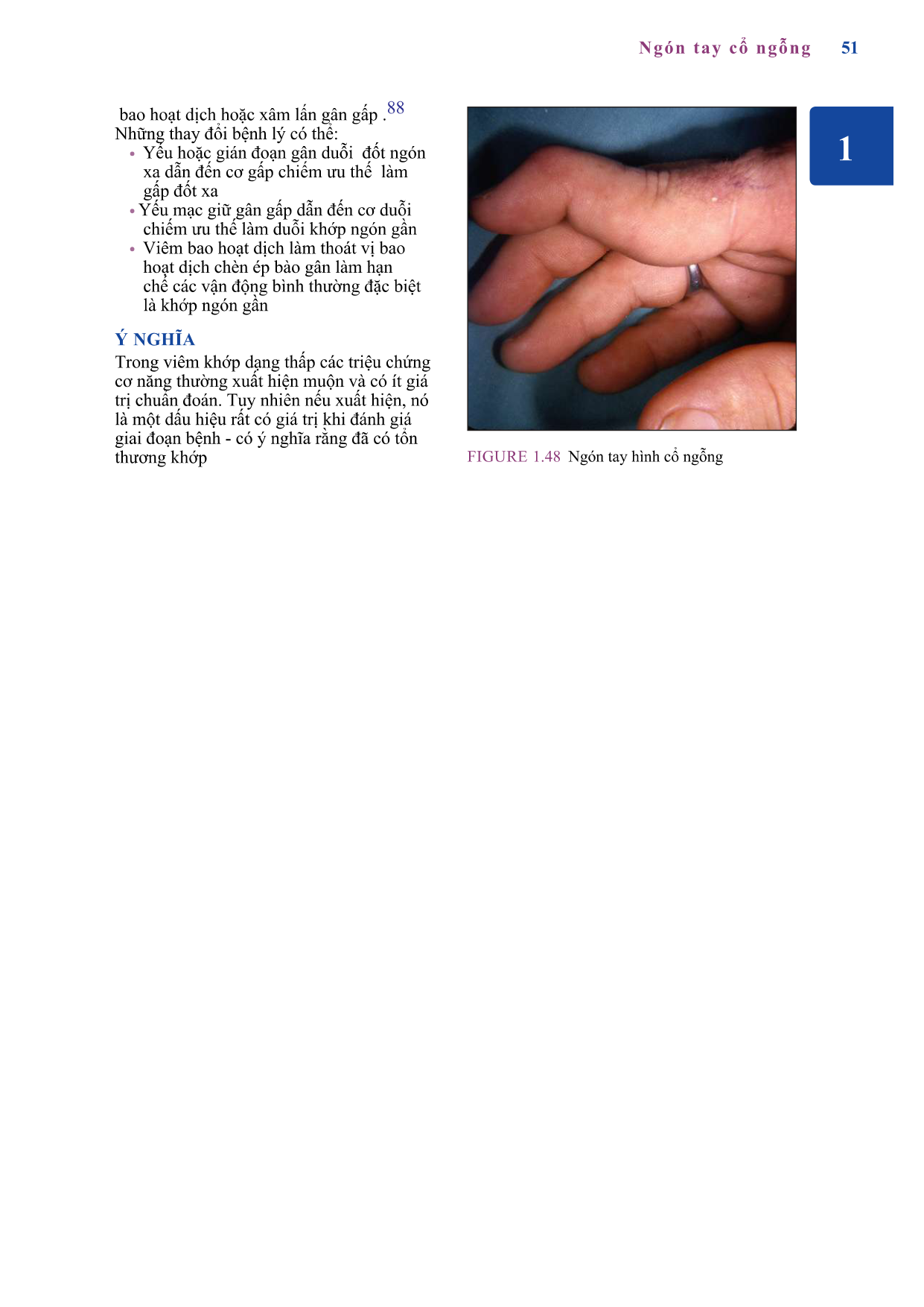 Dấu hiệu đường rãnh (Sulcus sign)
