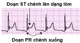 Điện Tim Viêm Màng Ngoài Tim: Tổng Quan, Chẩn Đoán và Điều Trị Hiệu Quả