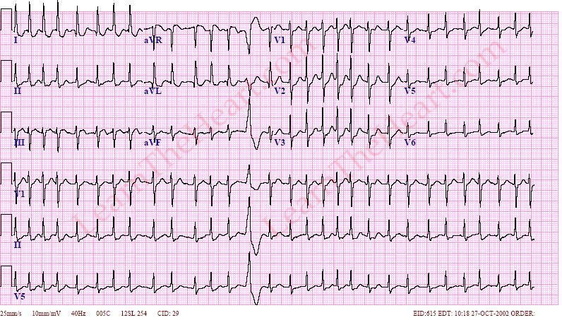 c-c-b-t-th-ng-tr-n-ecg