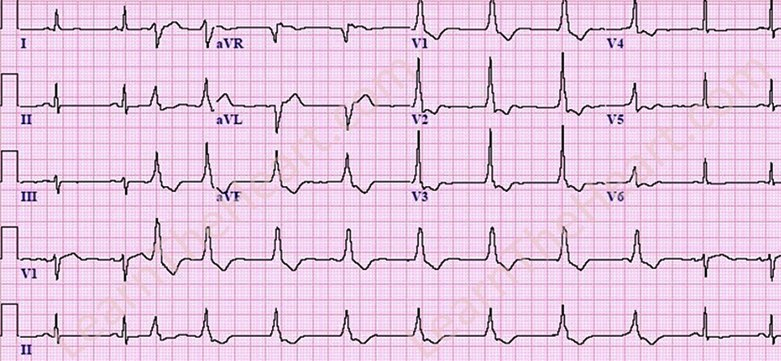 AIVR-ECG