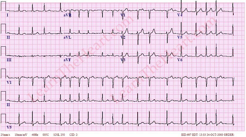 c-c-b-t-th-ng-tr-n-ecg