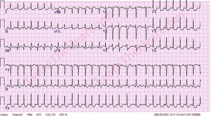 ecg-educator-blog-atrial-flutter-vrogue