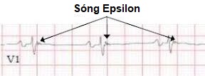 Epsilon_Wave