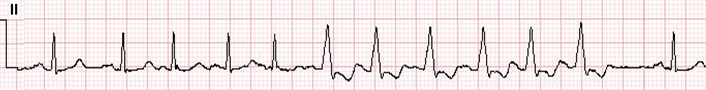 LBBB-RateDependent-Strip