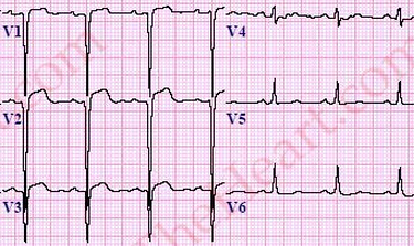 LeftVentricularLVAneurysmECG