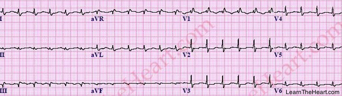 LowVoltageECGCriteria