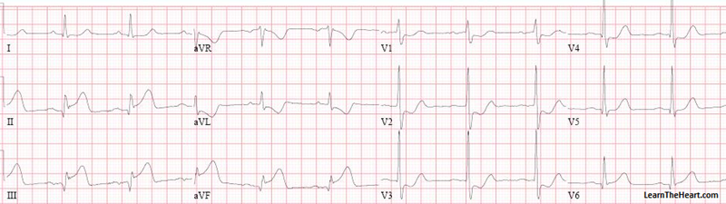 PosteriorMIECG-Small