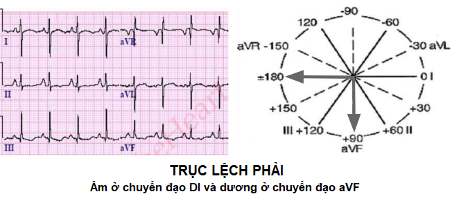 trục lệch phải