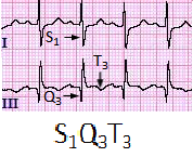 S1Q3T3-ECG-PulmonaryEmbolism