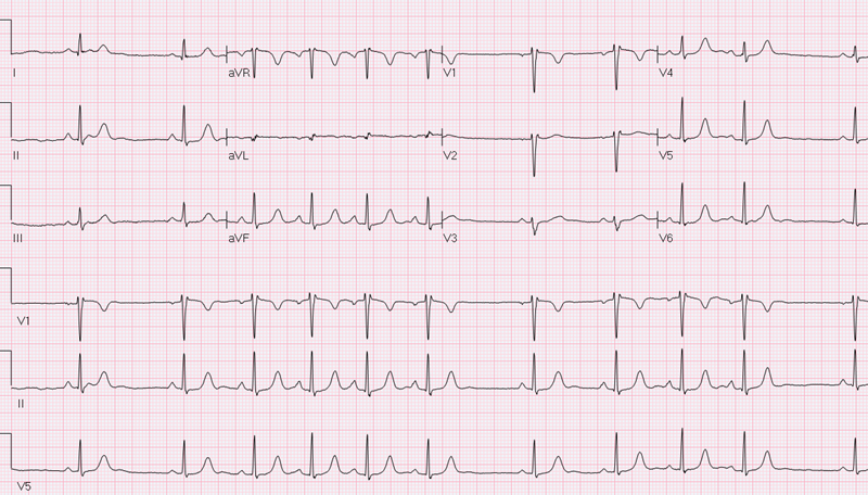 SinusArrhythmiaECG