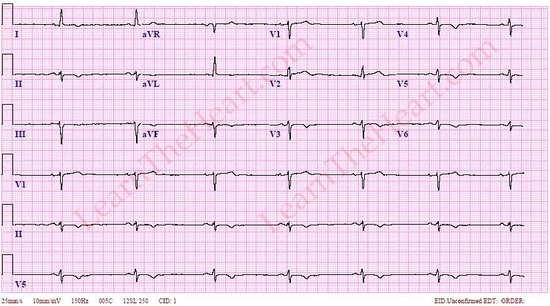 SinusBradycardiaECG